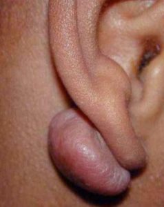 a-lump-behind-the-ear-lobe-picture