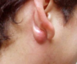 big-hard-lump-behind-ear-lobe