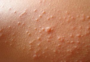 Rash On Arms And Legs Itchy Red Causes Small Bumps Pictures Not Itchy Skin Rash On Arms And Legs Baby Treatment Home Remedies