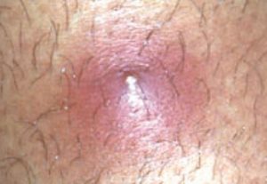 Ingrown Hair On Scrotum Testicle Sac Symptoms Pictures Causes