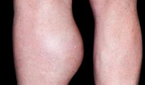 lump-behind-knee-bakers-cyst-image