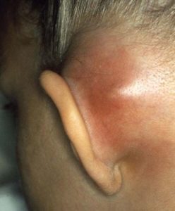 mastoiditis-infection-behind-the-ear-lobe