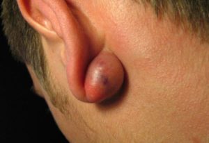 painful-cyst-lump-behind-the-ear