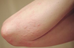 Rash on Arms Symptoms