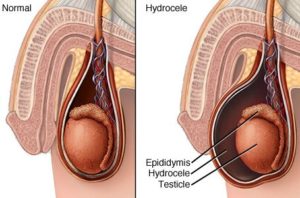 Scrotal Swelling Hydrocele Image