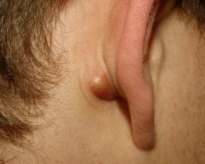 sore-pea-size-lump-behind-the-ear-lobe
