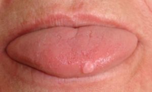 A Bump on Tip of Tongue