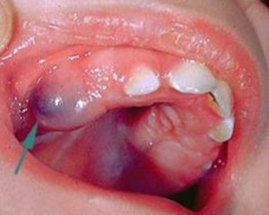 Blood Blister in Mouth