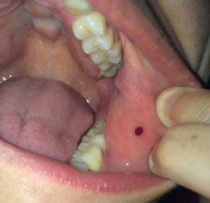Blood Blister Inside Mouth Cheek