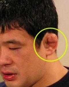 Swollen Ear Lobe Causes, Picture, Itchy, Red, No Reason, Lymph Nodes