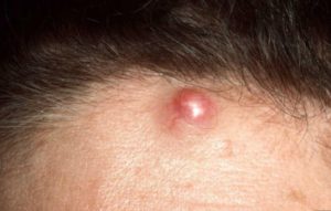 Cyst on Forehead