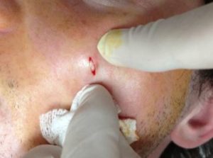 Cyst on Face Removal