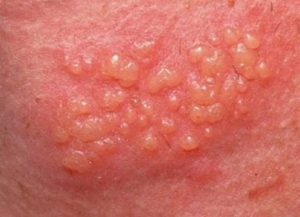 Genital Herpes Symptoms