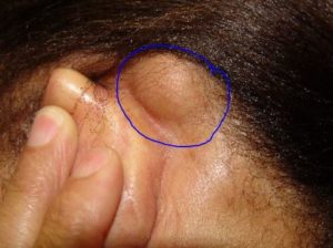 Large Bump behind Ear - Lipoma
