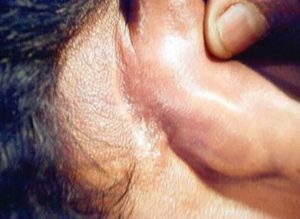 Mastoditis Infection on Ear
