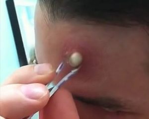 Popping a Cyst on Forehead