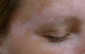 Vitiligo on Face Symptoms