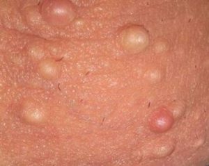 Pimple-like Dots on Testicles