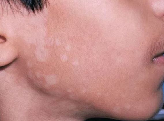How To Get Rid Of White Spots On Face Causes Pictures Pimple Like Patches Itchy Treatment