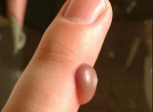 Image of Blood Blister on Finger