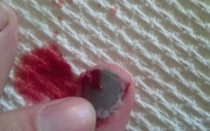 Blood Blister on Finger under Nail