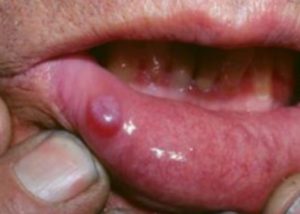 Blood Blister on Inside Lip