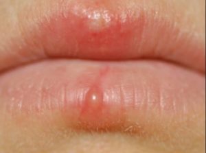 Blood Blister on Lip Symptoms