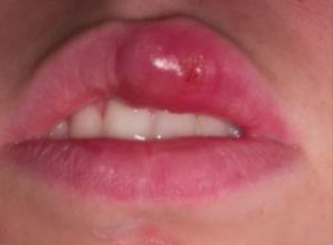 Blood Blister on upper lip