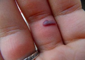 Blood Blister on Finger under Skin