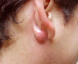 Cyst behind Ear