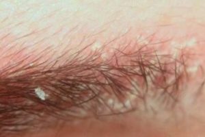 Eyebrow Dandruff, dry skin can be Itchy