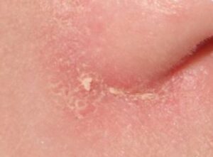 Itchy Nose Meaning Tip Allergy Treatment Home Remedy Treat MD
