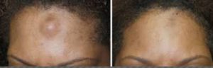 Forehead Osteomas before and after Treatment Picture