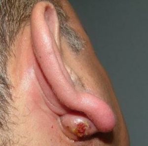 Infected Cyst behind Ear can be painful
