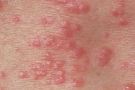 how to get rid of itchy rash between legs