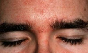 Itchy Eyebrows Causes