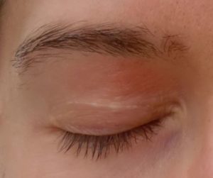 Eczema on Eyebrows 