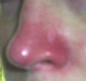 Itchy Nose Symptoms