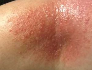Itchy Rash in Elbow Crease