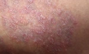 Itchy Rash on Inner Thigh Male