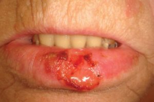 Lip Cancer Symptoms