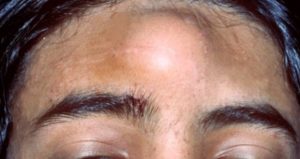 Lump on Forehead Picture