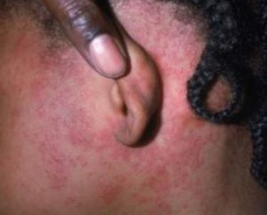 Measles Rash behind Ears