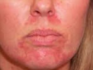 Periorificial Dermatitis on Lips and around Mouth