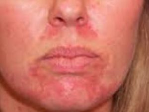 Rash Around Nose And Mouth 2