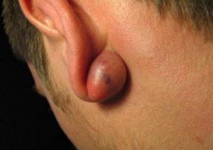 Picture of Cyst behind Ear