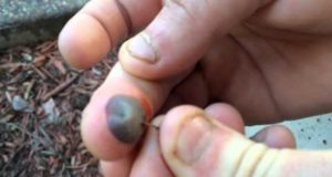 Popping a Blood Blister on Finger can result into an infection
