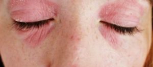 Image Result For How To Relieve Herpes Itching Image Result For How To Relieve Herpes Itching