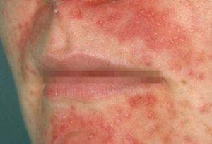 Rash around Mouth