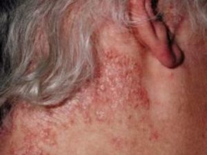 Skin Rash behind Ear and Neck Picture